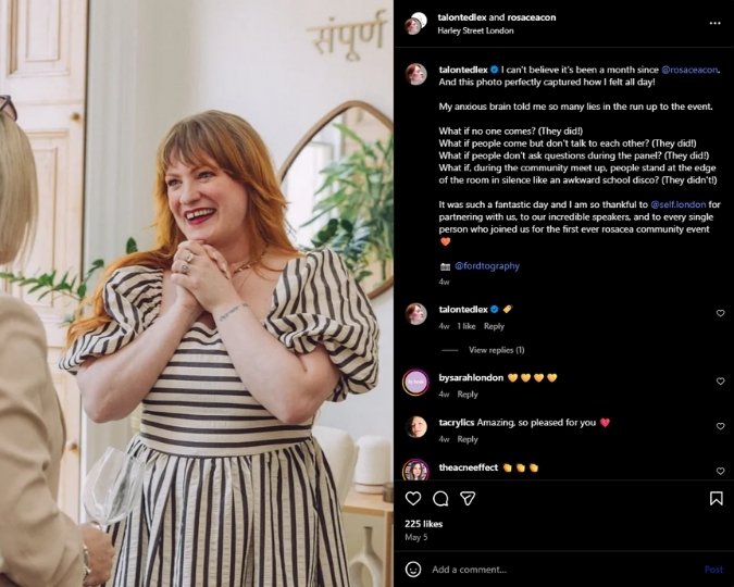Talonted Lex at rosacea community event in London, smiling in striped dress.